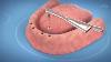 Dental Implants For A Toothless Jaw 3d Medical Animation