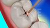 Dental Restoration With Waterlase Laser Dentistry Biolase