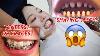 I M Finally Straightening My Teeth In Korea Invisalign Vs Braces Vs Veneers