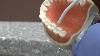 New Cavity Treatment Offers No Drilling No Filling