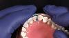 New Fusion Anterior Matrix System From Garrison Dental Solutions