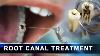 Root Canal Treatment Step By Step Curveia Dental Animation In 3d Endodontics For Tooth Decay