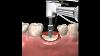 Step By Step Dental Implant Surgery Gary R O Brien D D S
