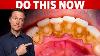 The 1 Top Remedy For Dental Plaque Cavities And Gingivitis