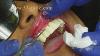 Couronnes Et Ponts Dentaires Procédure Chez Les Associés Dentaires Cosmétiques À San Antonio Tx