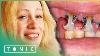 Décaissement Des Dents Besoin De Soins Médicaux Grande-bretagne S Pires Dents Tonique
