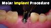 Étape Par Étape Implant Dentaire Procédure Retour Molaire