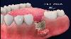 Implants Dentaires Par Mis Matrix Surgery Guide 3d Animation Dental Tutorial