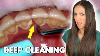 Nettoyage Profond Avec Le Tartar Lourd Construire À La Dentiste