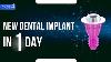 Nouvelle Implant Dentaire En Un Jour Comment Utiliser Cad Cam Et D'autres Avantages De La Technologie Dentaire