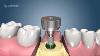Procédure D'implant Dentaire Deux Étapes